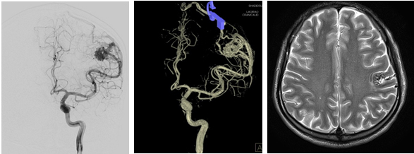 뇌동정맥 기형사진