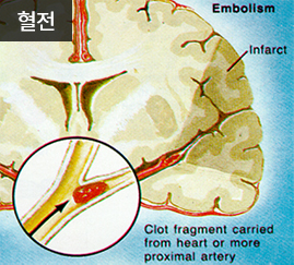 뇌경색 종류 뇌혈전증