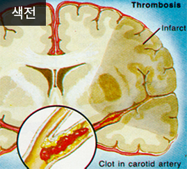 뇌경색 종류 뇌색전증