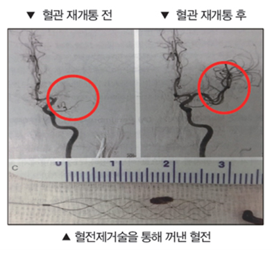 뇌경색의 치료 사진